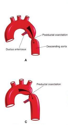 Suprasternalt Aortabue med