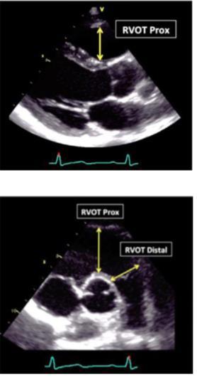 HV linjære dimensjoner (utløp HV) Proksimale RVOT langakse (20-30mm) Fremre HV til basale septum i PS endediastole Proksimale RVOT