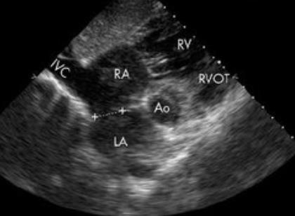 Subcostal Situs Aorta desc og VCI Innmunning VCI/VCS til HA Lungevene innmunning