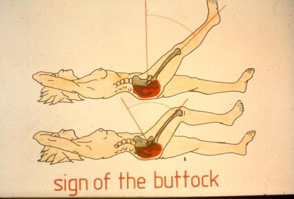 Alvorlig patologi Ischiorectal abscess Sacral fraktur Femur neoplasme Ilium neoplasme Osteomyelitt av femur Septisk ilio-sacral artritt Stor funksjonssvikt Feber,