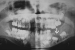 Oral and Maxillofacial Pathology 2017 58 Ameloblastisk fibrom Røntgen: Uni- eller multilokulær radiolucens