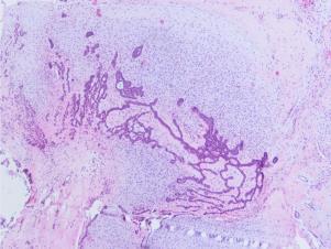 Ameloblastisk fibrom Inndeling Mesenchymale odontogene