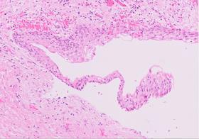 Follikulærcyste Histologi Smalt