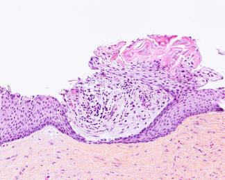 Hyaline legemer (ikke kasus 18) Keratocyster