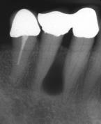 keratocyste Keratocystisk odontogen tumor KOT (WHO