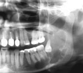 Gorlins syndrom/nevoid basalcellecarcinomsyndrom i 5%