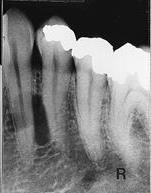 Lateral periodontalcyste og gingivalcyste Lateral