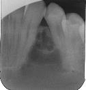 lateral periodontalcyste I bløtvev (Serres perler) =