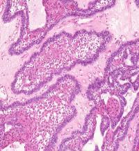 Oral and Maxillofacial Pathology 2017 44 (Solide/multicystiske) Unicystisk ameloblastom Røntgen: