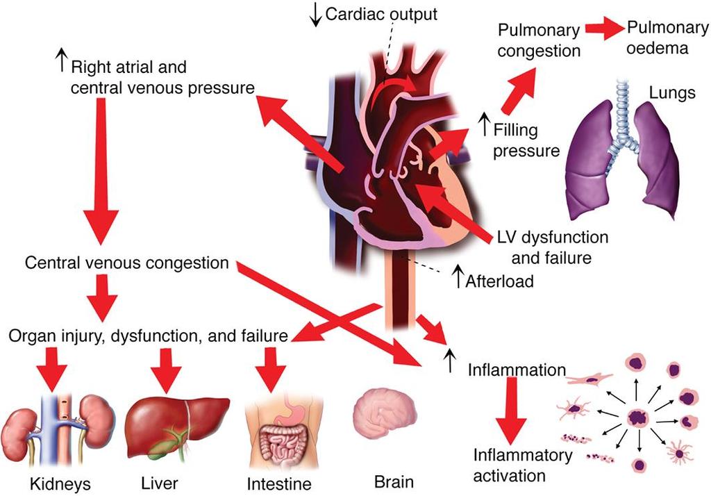 Organ dysfunction, injury and failure in acute heart failure: from pathophysiology to diagnosis and management.