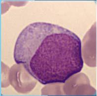 Akutt leukemi Ukontrollert vekst av umodne blodceller X X X 3 Akutt