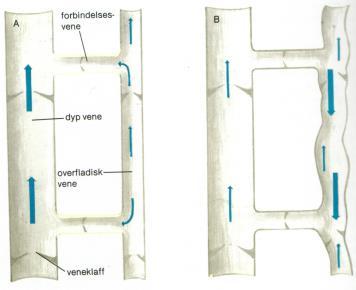 ved venøs svikt Blodet går i