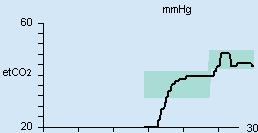 Drift Parameterfelt for etco2-trend Parameterfelt for historikk SVC-etCO2 SVC-hend.forløpet SVC-f SVC-Pinsp 01:15:10 10 -> 9 16 -> 17 A 311 Trenden for etco2 tas opp for de siste 30 minuttene.