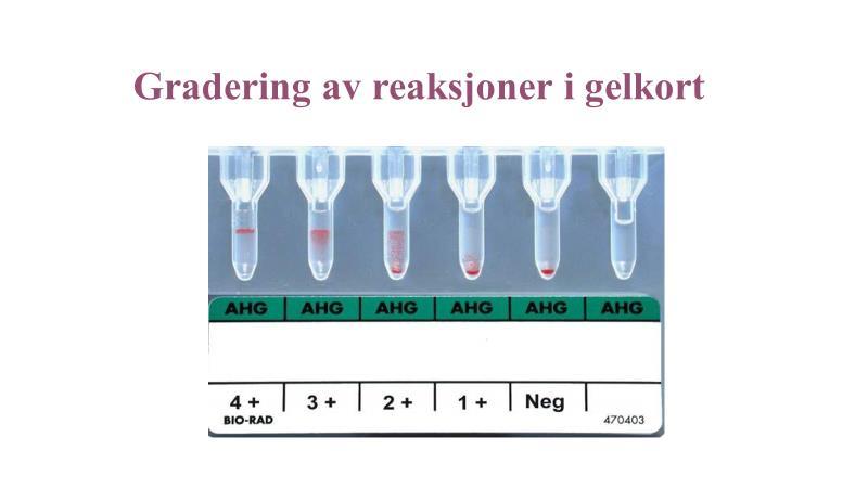 0 poeng: Svarer ja selv om sensor presiserer at pasienten ikke vil blø seg i hjel uten umiddelbar transfusjon. Svarer nei, men med helt gal begrunnelse, eller sier nei og kan ikke begrunne (gjetning?