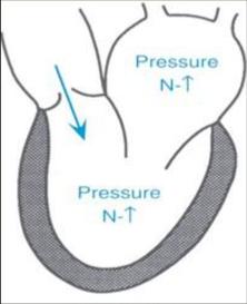 Detaint et al, JACC 2008 Hemodynamik ved AI Akutt AI Kronisk AI Adapted from: Lilly L.