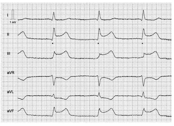 STEMI (Myokardinfarkt med ST-hevning) II Symptomer og funn II Tachykardi eller