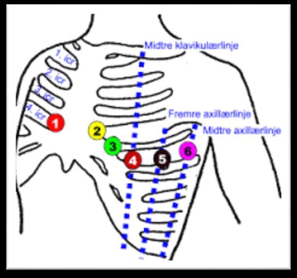 EKG Viktig med teknisk gode EKG Plassere elektrodene riktig og godt Pasienten må ligge