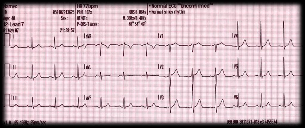 EKG uten forstyrrelser