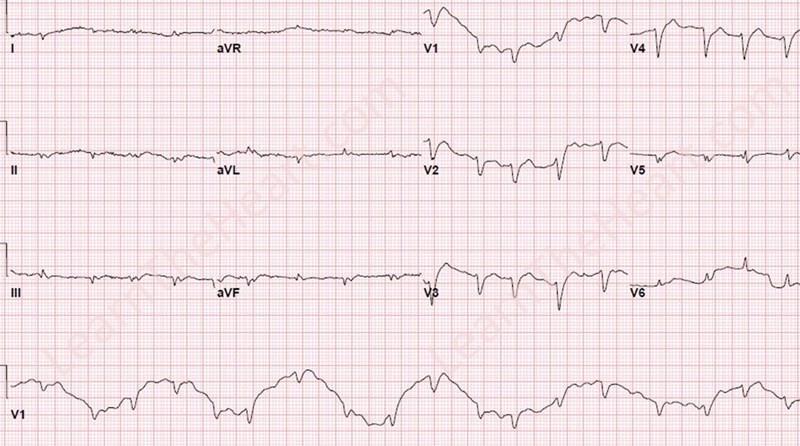 Forstyrrelser i EKG