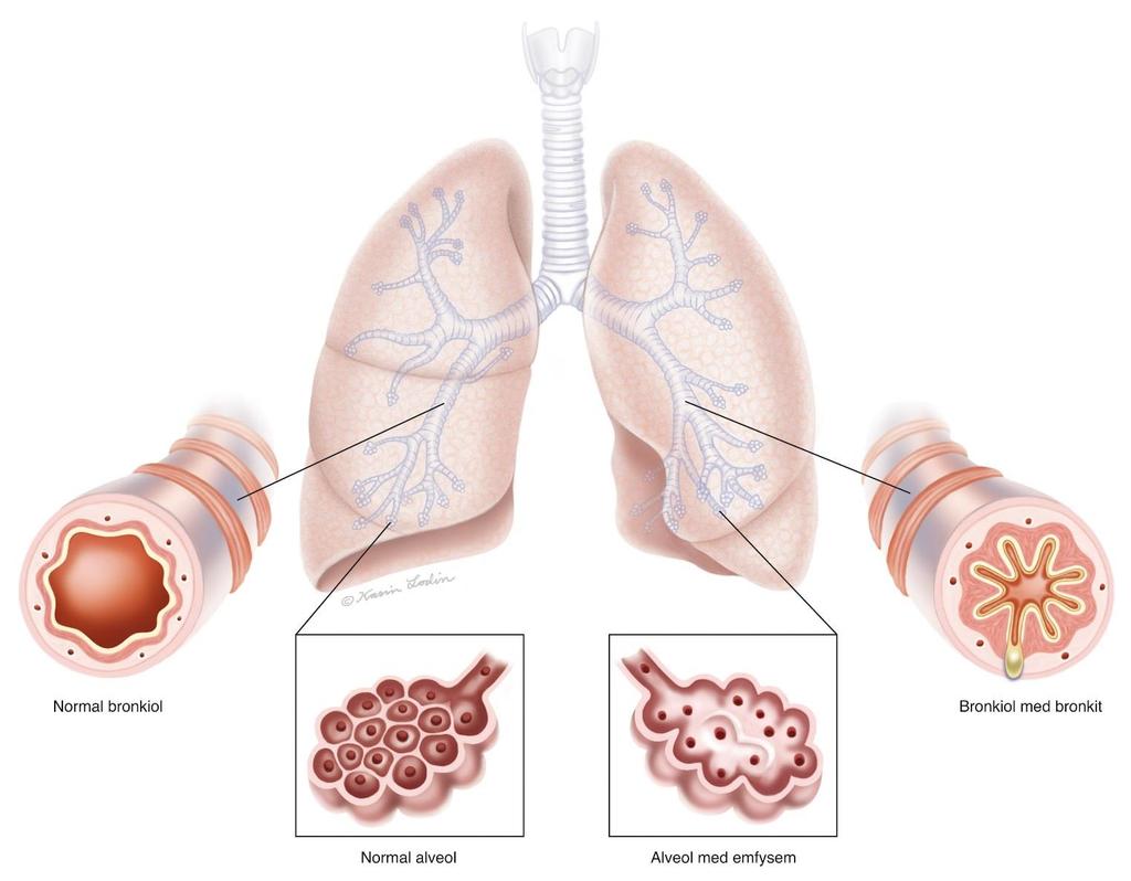 Bronkitt/Emfysem