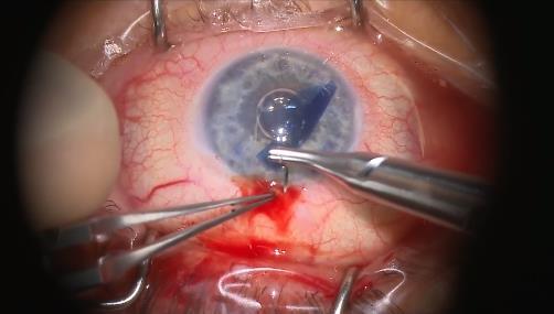 The camera features the latest-generation image sensor technology from SONY, designed for medical microsurgical applications including ophthalmology and neurology procedures.