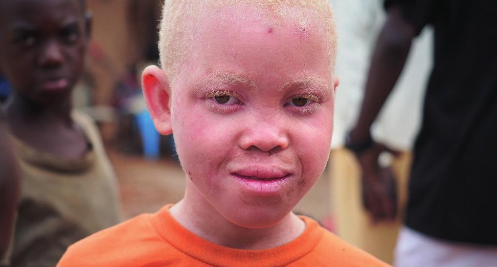 DINA-STIFTELSEN HAR BYGD BARNEHHJEM I UGANDA Tekst: Albino som får hjelp i Uganda. Foto: Rune Edvardsen.