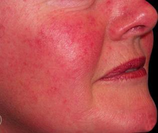Symptomer på stigende CO 2 Hodepine Varm, klam og rødblussende hud Roligere respirasjonsfrekvens Mer overfladig
