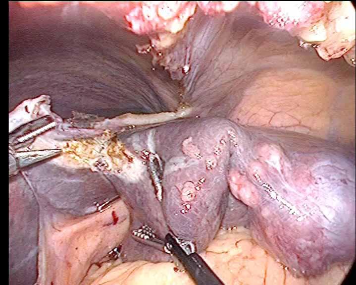Utvikling av kikkhullskirurgi ved IVS Operasjoner spiserør 1996 Fjerne binyrer 1996 60% av leverreseksjoner i OUS blir gjort som kikkhullskirurgi Fundoplicatio redo 1996 Tykktarm operasjon 1996