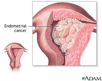 Arv: 1 av 10 tilfeller av eggstokkreft har en arvelig disposisjon for både denne kreftformen og for brystkreft.