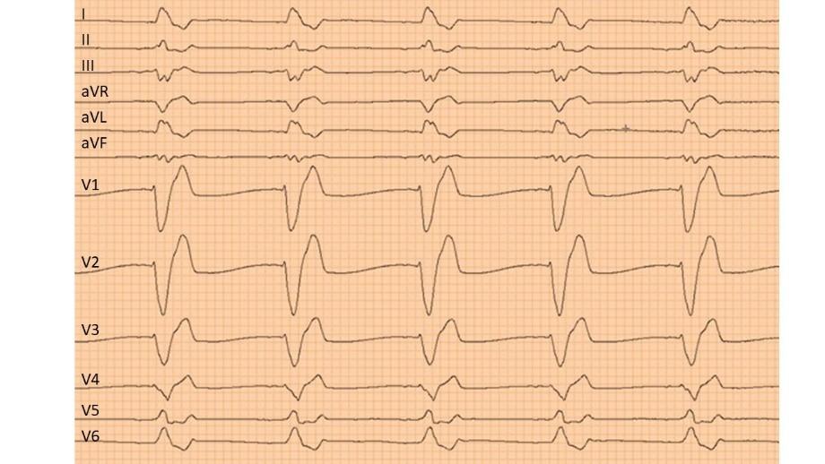 A Elektrofysiologisk undersøkelse Ikke aktuelt her B X Ekkokardiografi Pasienten har sviktsymptomer og biomarkører som tyder på hjertesvikt (signifikant forhøyet NTproBNP).