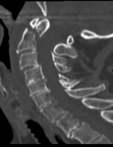 A B Gastroenteritt Toxisk megacolon Gir ikke dilatert tynntarm C X Mekanisk ileus Gir væskespeil i ulike nivåer (slik som denne casen).
