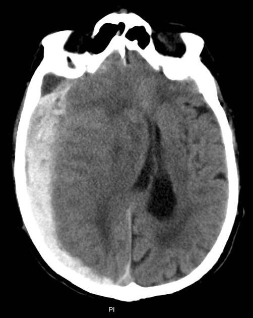 Hva er pasientens diagnose? A Diffus aksonal skade B X Akutt subduralt hematom Hyperdens lesjon som ligger utenpå hjernevevet. Følger konveksiteten og er ikke avgrenset av suturer.