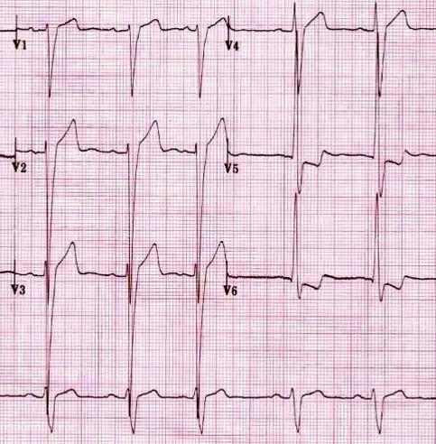 A Mitrallekkasje B X Aortastenose Pasienten har klassiske symptomer aortastenose. EKG viser tegn til venstre ventrikkelhypertrofi som også er vanlig ved aortastenose.