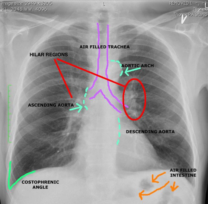 The important and recognizable structures of the mediastinum are the heart, ascending and de- scending aorta, the aortic arch and lymph nodes (Image 1).