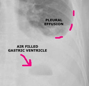 6) Costophrenic angle Locate the costophrenic angle where the diaphragm and the chest wall meets. It should be clear and sharp on both sides and forms an acute angle (Image 1).