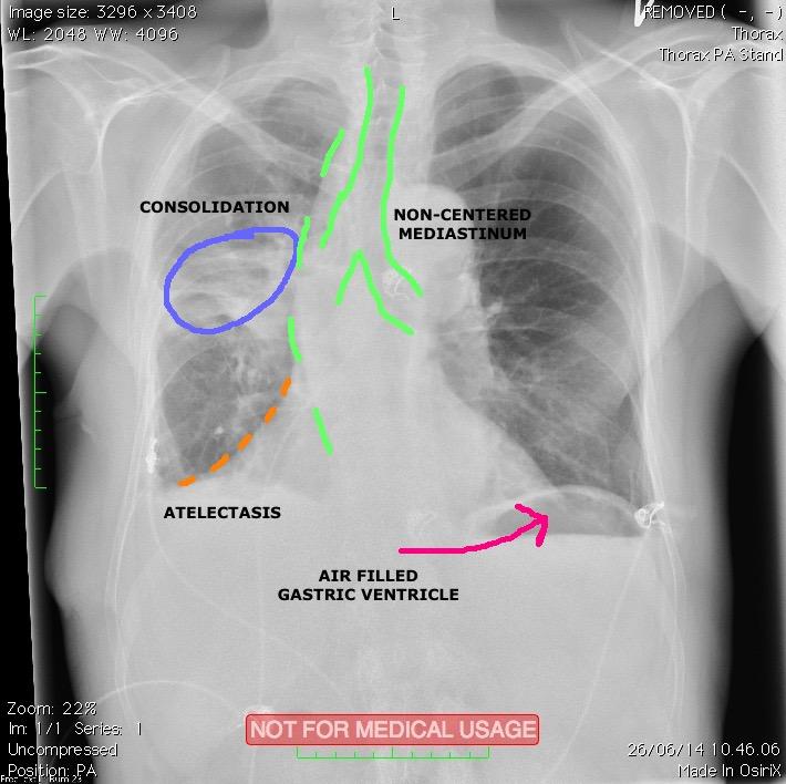 Compare the right and left of each zone and look for any asymmetry that is not explained by the normal structures: Is an area of the lung either too black or too white?