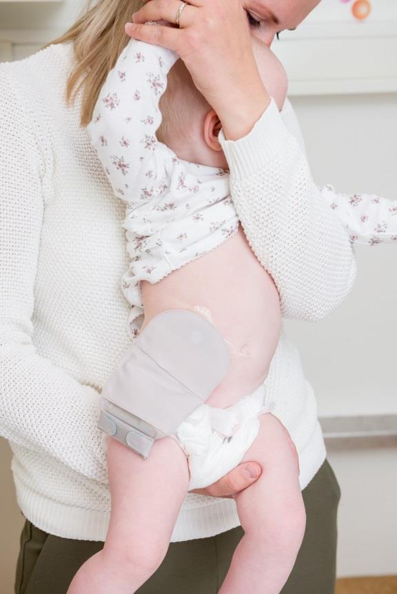 Psykososialt Det er viktig at eldre barn er godt forberedt og forstår bakgrunnen for at han eller hun får stomi. Dette gjør det lettere å akseptere stomien.