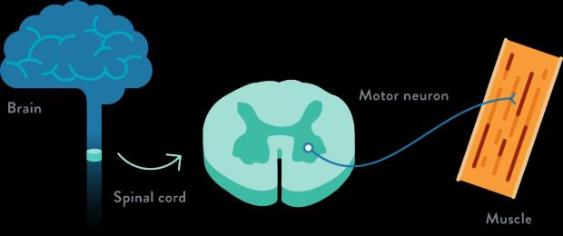 Spinal muskel atrofi SMA Død/henfall av motoriske neuroner i forhornet av medulla