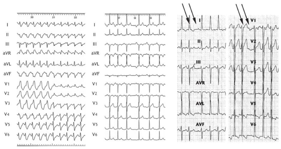 22 ESC Guidelines A B C Figure 7 Focal atrial tachycardia (A) Focal atrial tachycardia originating at the lateral right atrium conducted initially with full and then incomplete right branch bundle