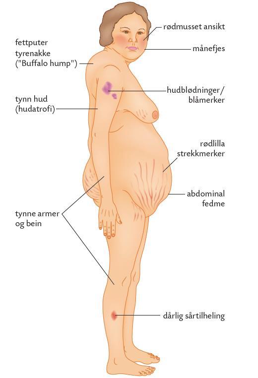 Trøtthet + tilleggsymptom kan være hormonsykdom Vekt(utvikling)?