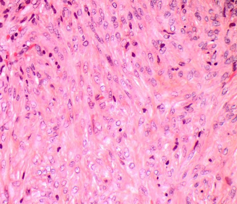 Myoepteliom Benign spyttkjertelneoplasm (<1,5%) - kvinner=menn, hyppigt i 30-60 års alder - Kapsel - Vanligst spolformete celler (vs.