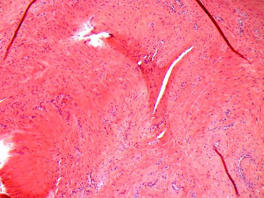 Leiomyom Benign mesenchymal tumor med glatt- muskulatur- differensering.