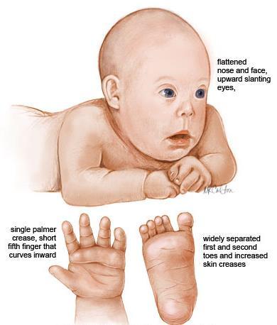 Down syndrom Vanligste årsak til utviklingshemming (Forekomst I:1000 fødsel i Norge) Karakteristisk utseende: - Smale og skråttstilte øyeåpninger - Hudfold over den indre øyevinkelen - Åpen munn med