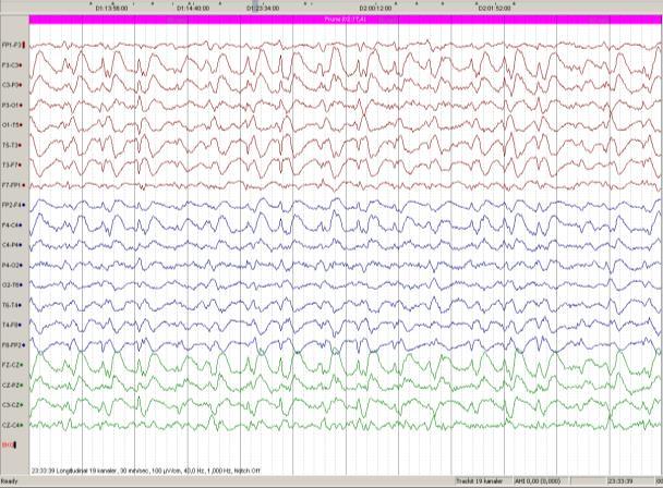 Spesifikke funn i EEG Mange ulike årsaker: - Genetisk - Ulike typer tidlige hjerneskader Vanskelig epilepsi som