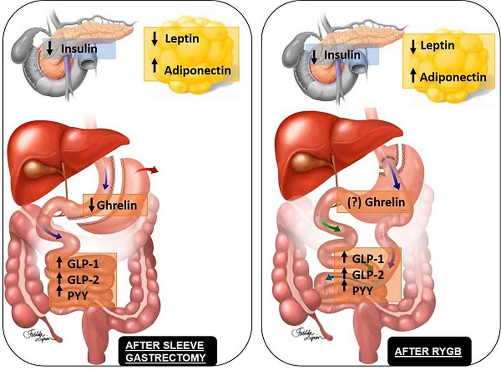 Energibalansen etter bariatrisk kirurgi GLP-1, glucagon-like peptide 1; GLP-2,
