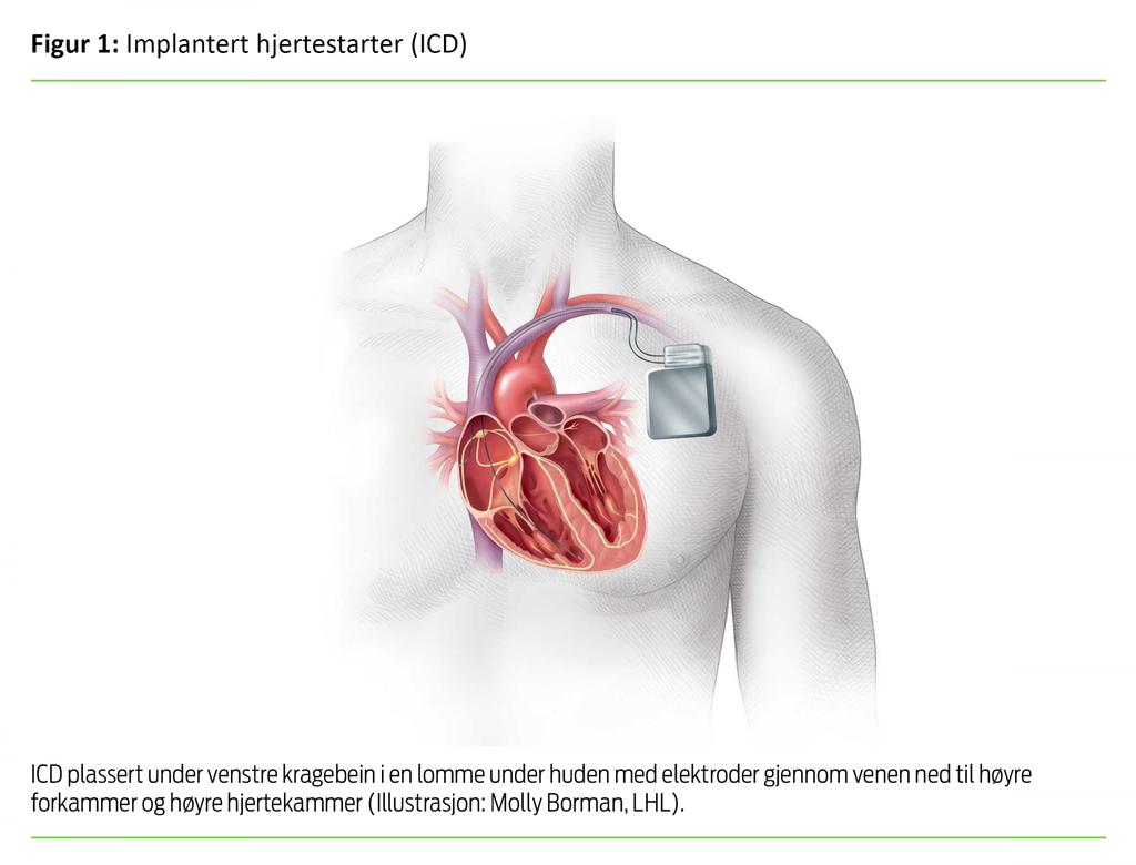 En ICD registrerer (senser) hvordan hjertet slår.