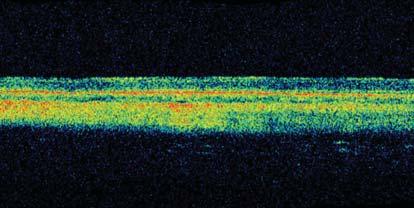 A polyimide-based gold electrode had been implanted. Under gross inspection, the electrode is in its original position near the visual streak and no chorioretinal abnormalities can be found.