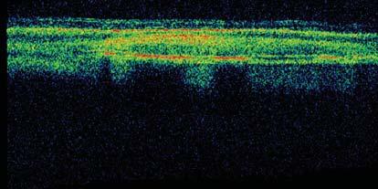 (c) The OCT scan passing the electrode vertically (the dashed line in the fundus photography). The electrode is observed in the suprachoroidal space and in tight contact with the choroid.