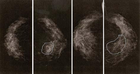 Previous Recent Detail Figure : Left to right: longitudinal progression of a distortion (digitized from L. Tabár archive).