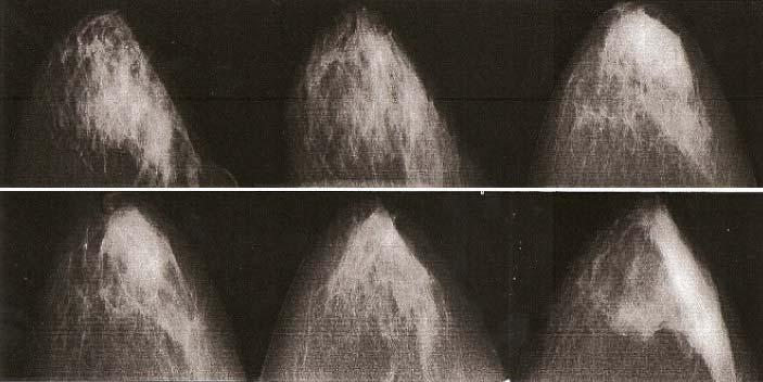 Figure 15: Example of a taxonomic class. Figure 1: Example of a taxonomic class. Figure 16: Example of a taxonomic class. 6. REFINING THE MAMMOGRAM TAXONOMY 6.1. Input feature selection The main weakness with the current classification scheme is considered to be the manual specification of the image features which were extracted from the mammograms.